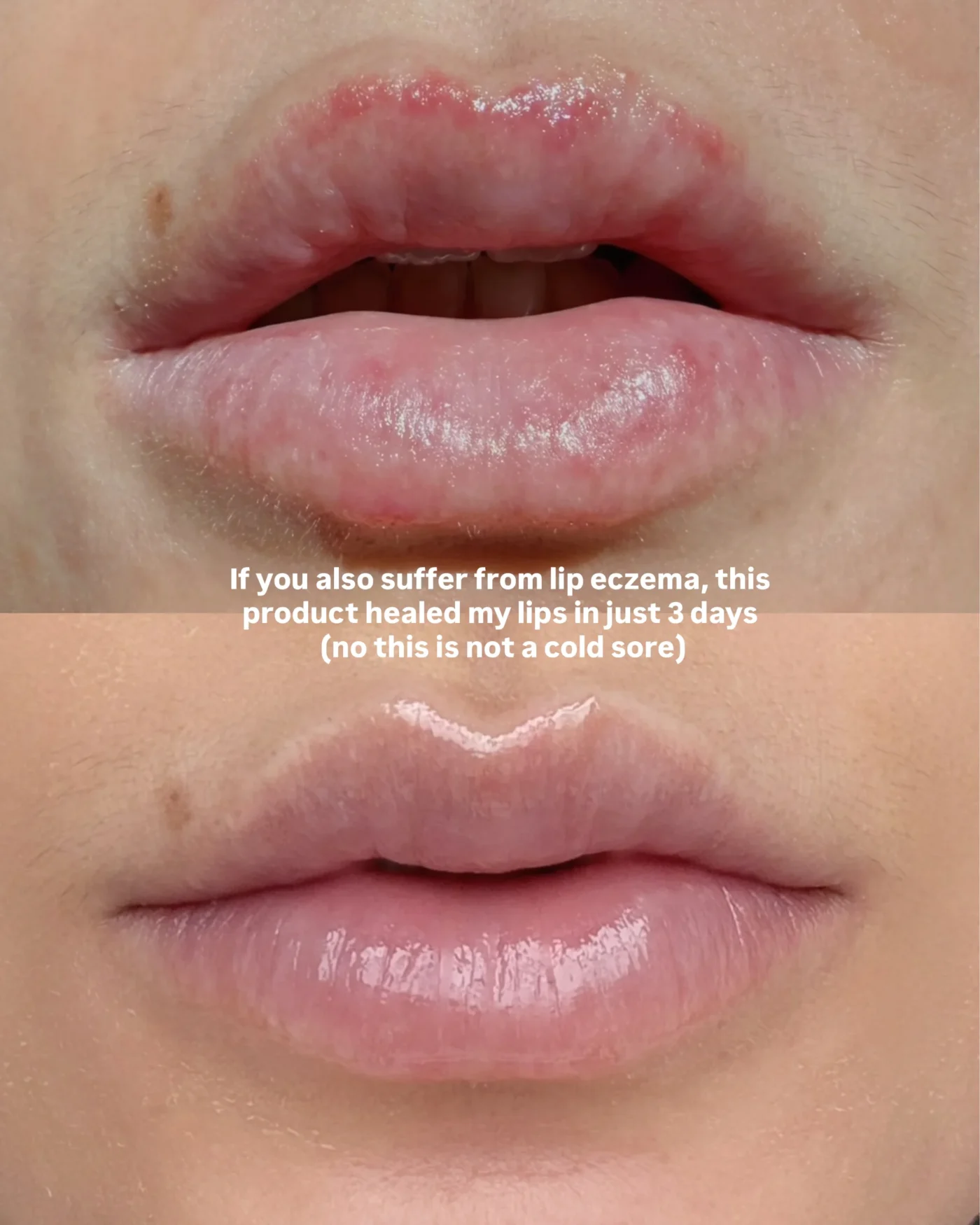 Lip eczema healed in 3 days